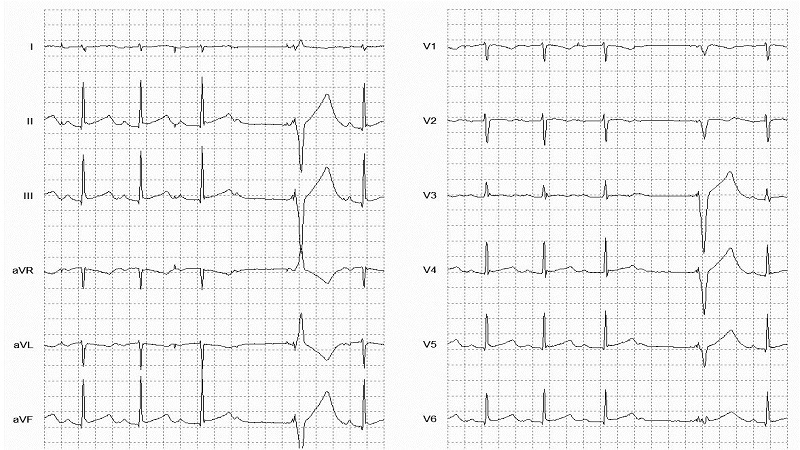 Atrial Paced Beat 12 Lead EKG